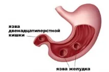 симптоми стомаха