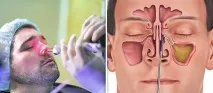 максиларния синус лечение синузит
