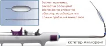 синусопластика синусопластика