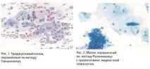 Цервікальний скринінг раку
