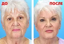 клепачите термаж
