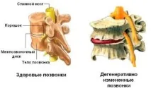 Дегенеративні зміни хребта Що таке, види види