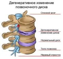 Дегенеративні зміни хребта Що таке, види зміни