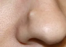 максиларната кухина миома