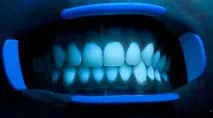 ФЛУОРЕСЦЕНЦІЯ КОМПОЗИТНИХ МАТЕРІАЛІВ - Dental Magazine флуоресценція