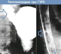 причини гастроезофагеален