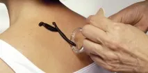 хирудотерапевтични остеохондроза