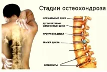 хирудотерапевтични хирудотерапия