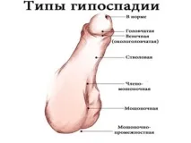 Гіпоспадія причини, симптоми,діагностика та лікування гіпоспадія