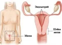 Як зупинити маткову кровотечу при міомі матки маткову