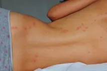 Який лікар лікує лейкоцитокластичний (шкірний) васкуліт симптоми, форма, лікування, фото який