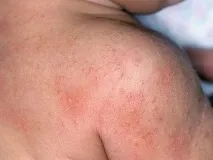 Який лікар лікує лейкоцитокластичний (шкірний) васкуліт симптоми, форма, лікування, фото який