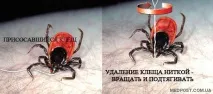 Як правильно витягнути кліща у людини витягнути