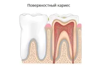 Як проводиться лікування поверхневого карієсу у дорослих та дітей карієсу