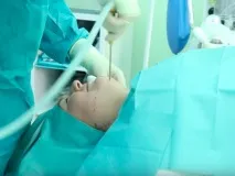 Як прибрати «друге» підборіддя та щоки безопераційні та хірургічні методики щоки