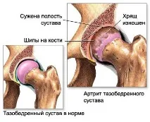 тазобедрените стави