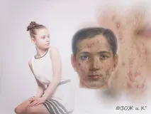 блогът акне