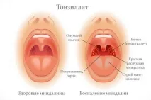 Як лікувати тонзиліт гострої та хронічної форми форми