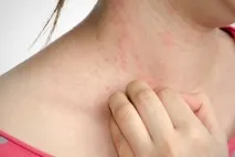 лишай