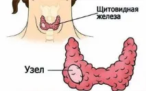 щитовидната причини