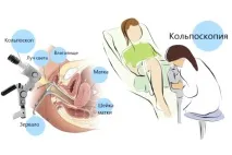 Кольпоскопія при ерозії шийки матки мета, проведення, результати кольпоскопія