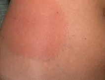 компресирайте димексид