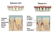 Лікування пародонту та слизової оболонки - Стоматологічна клініка «Нео-Дент» оболонки