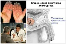 Лікування хламідійного простатиту простати