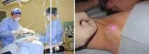 хиперхидроза подмишниците