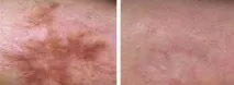Лікування стрій, розтяжок, шрамів у «Гармонія SPA» - ціни, відгуки шрамів