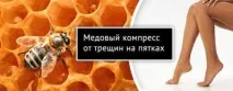 Лікування тріщин на п’яті медом, народними засобами в домашніх умовах народними