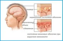 Ускладнення гаймориту, чим вони небезпечні і що робити гаймориту