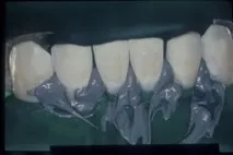 Пародонтальне шинування за допомогою Ribbond THM (частина 2) ribbond