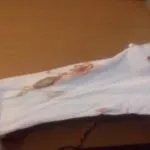 Після Кліону Д виділення рожеві, кров’янисті, при місячних, вагітності рожеві