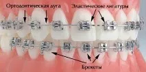 Популярно про встановлення брекетів встановлення