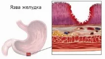 Ознаки виразки шлунка, симптоми, діагностика та лікування ознаки