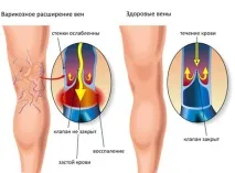 профилактика краката
