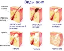 Прищі на обличчі – як позбутися, найкращий засіб від прищів прищі