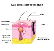 Прищі на обличчі – як позбутися, найкращий засіб від прищів найкращий