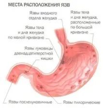 Ознаки виразки шлунка, симптоми, діагностика та лікування симптоми