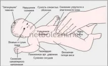 Зневоднення організму симптоми у дорослої та дитини зневоднення