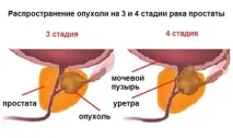Рак простати симптоми та ознаки простати