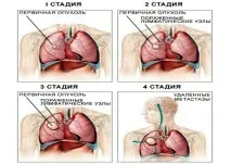 Рак двох легень що це таке, прогноз виживання та симптоми легень