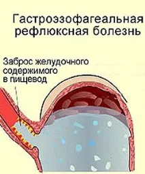 Розлад шлунка симптоми, лікування, що можна їсти розлад