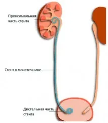 міхура