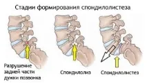 спондилолистеза лумбалния