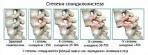 лумбалния спондилолиза