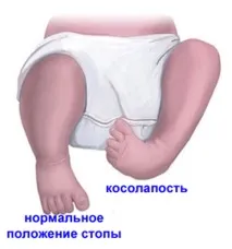 Стрес перед пологами та післяпологовий стрес причини та методи позбавлення стрес