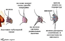 Тубулярні груди грудей