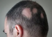 алопеция ареата алопеция ареата